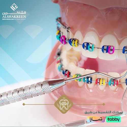 تقويم الاسنان | عيادات الشاكرين